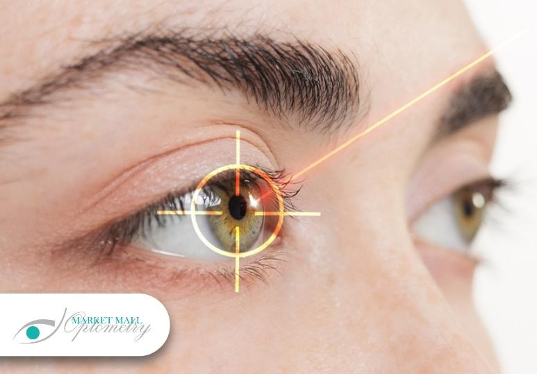 Is LASIK Right for You? Calgary Optometrist’s Guide to Vision Correction